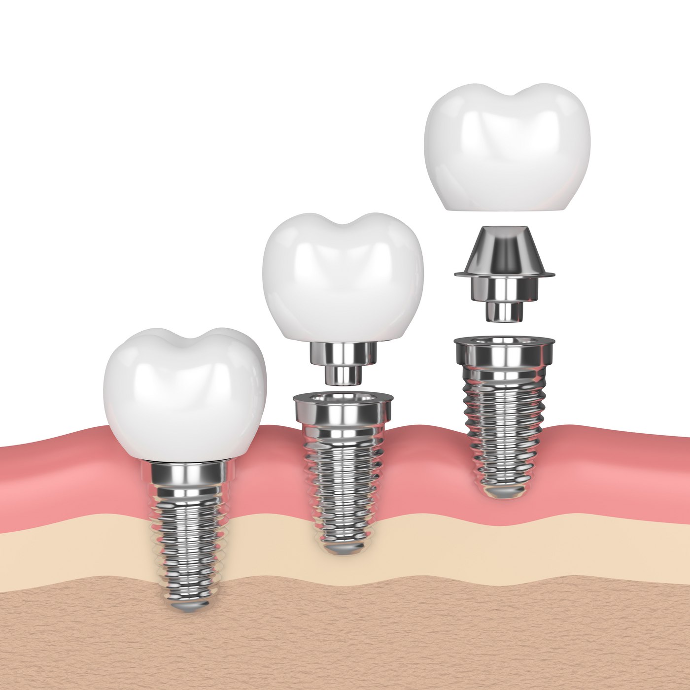 Implant Image