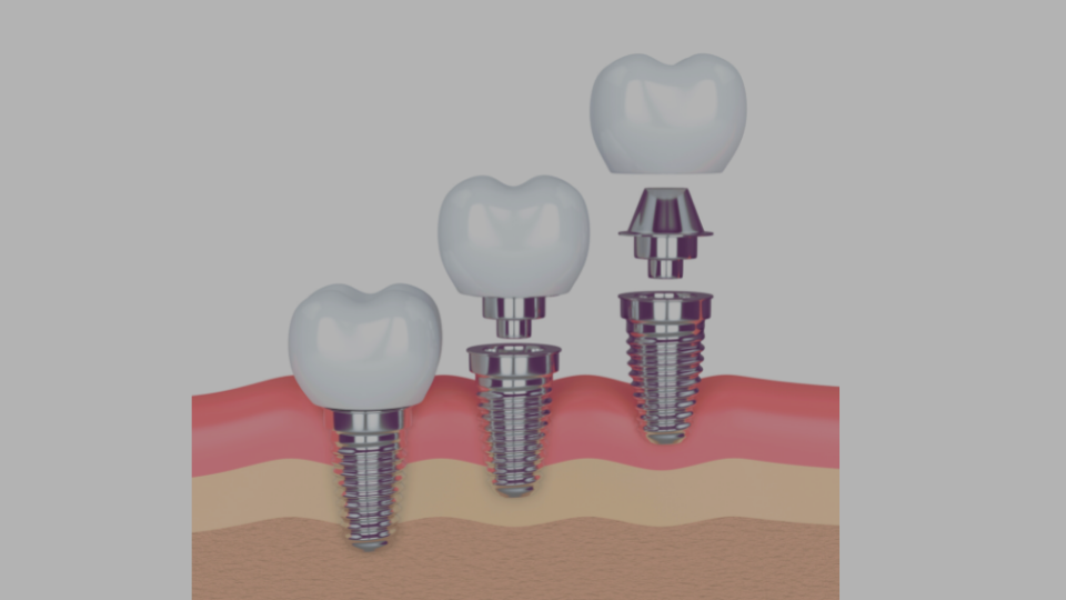 inar Implant Services Dental Claim Support